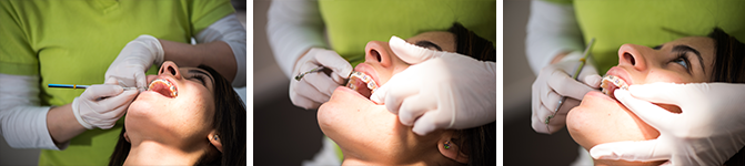 slotjesbeugel orthodontie