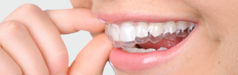 invisalign beugel orthodontie