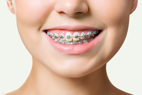 slotjesbeugel orthodontie