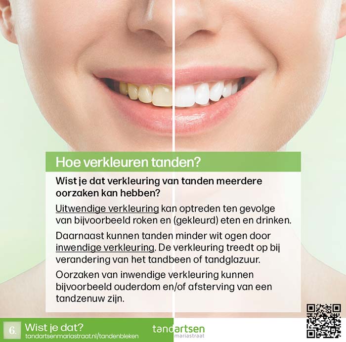verkleuring tanden