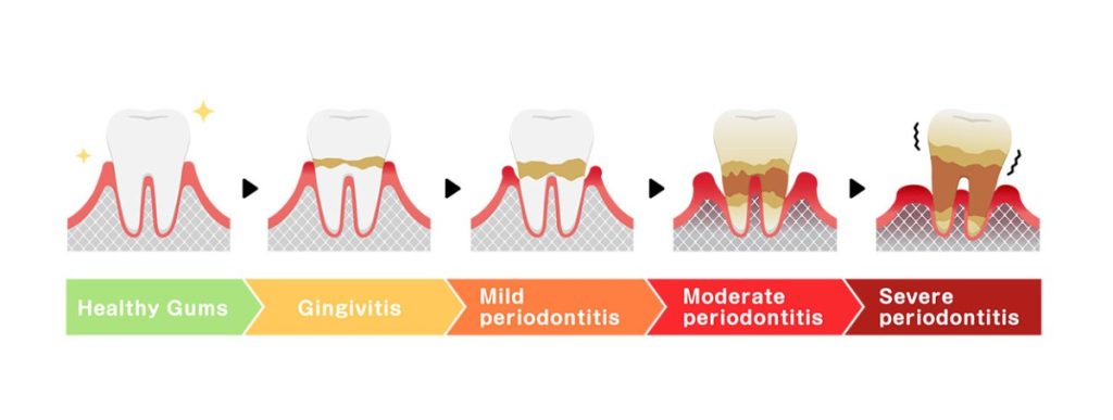 mondhygiene parodontitis fasen